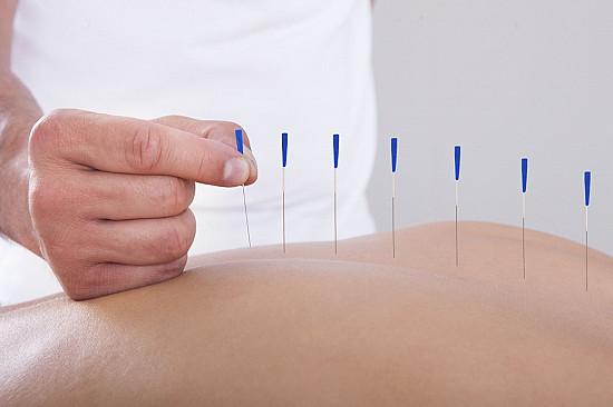 Acupuncture therapy for wellness and stress relief